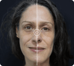 Microlifting estético facial