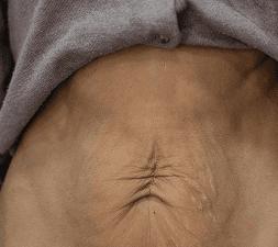 Remodelación y celulitis